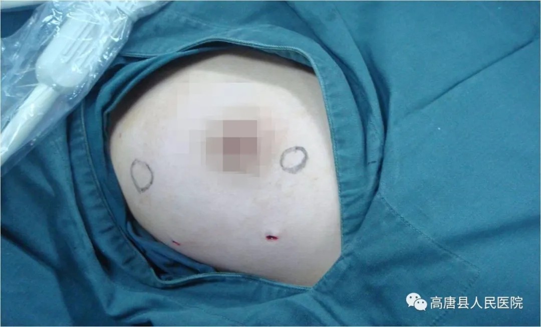 我院自开展乳腺肿瘤微创旋切手术(即麦默通技术)以来,已为十余名乳腺